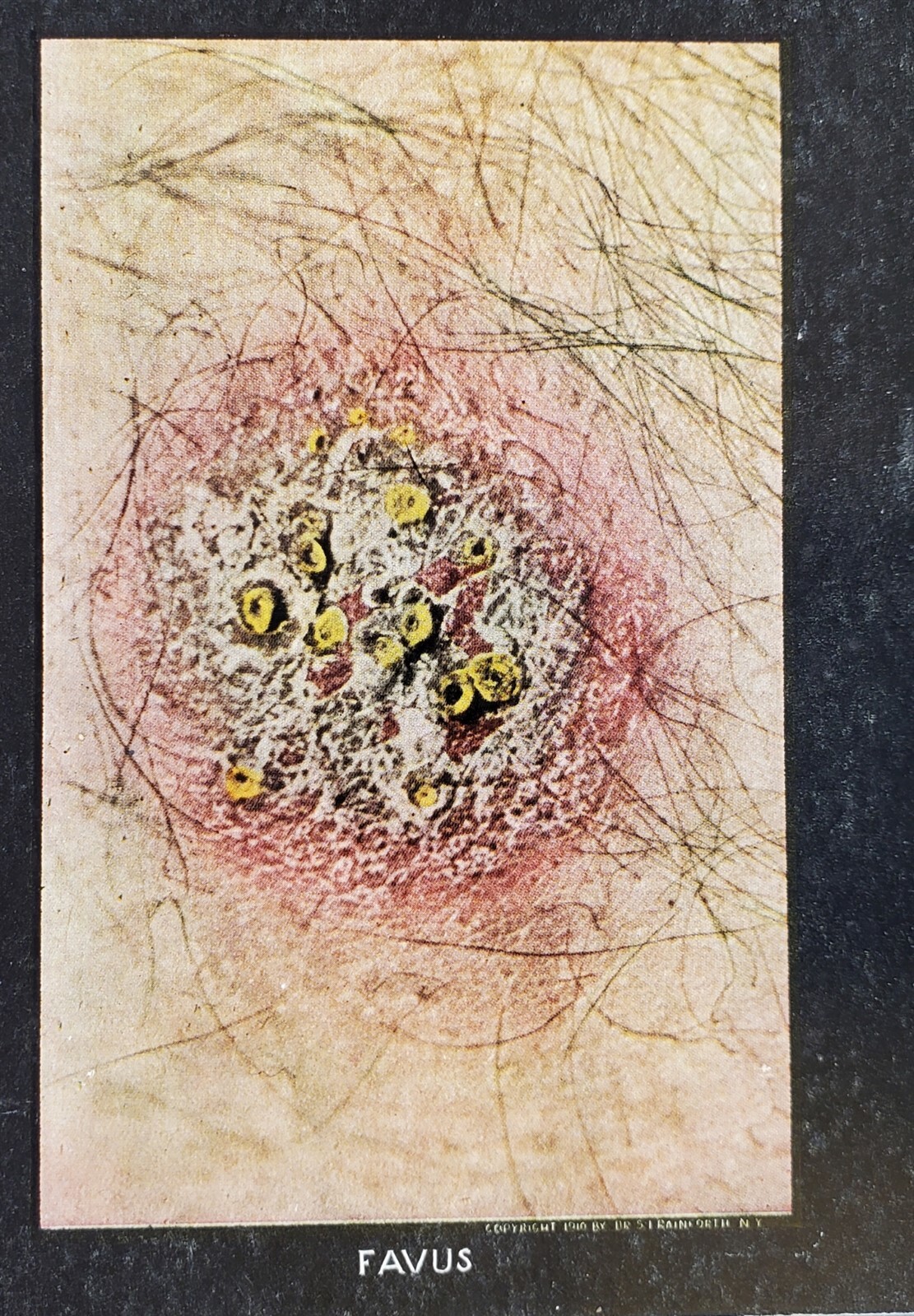 ANTIQUE 1910 MEDICAL SKIN DISEASE STEREOVIEW CARD FAVUS #35 RAINFORTH
