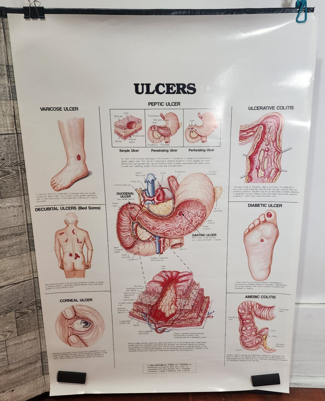 1985 Ulcers Dr. Office Poster Chart  by Earnest W. Beck 20"x29" Anatomical #29