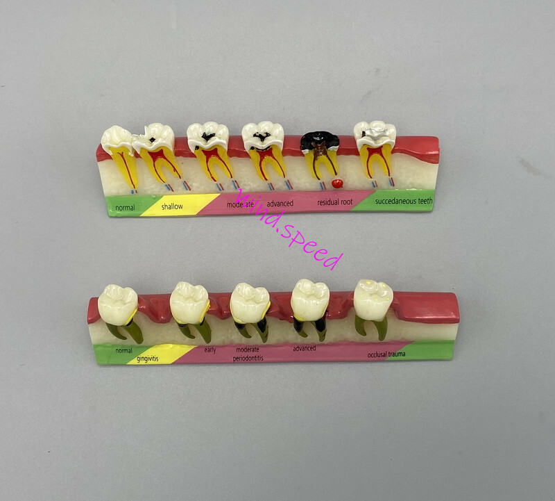 Dental Teeth Dentoform Models Caries Periodontal Disease Study Teaching Model