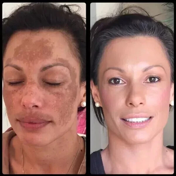 Advanced Plus Scar Purple Softer, Smoother And More Elastic Gel- 10 g