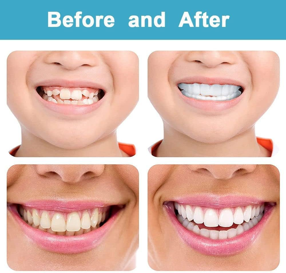 Top and Bottom Snap-On Fake Teeth Cover for Broken or Missing Teeth