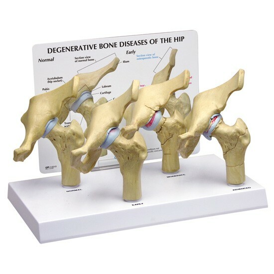 Hip 4-stage Osteoarthritis Anatomical Model  LFA #1320 See VIDEO! Make An Offer!