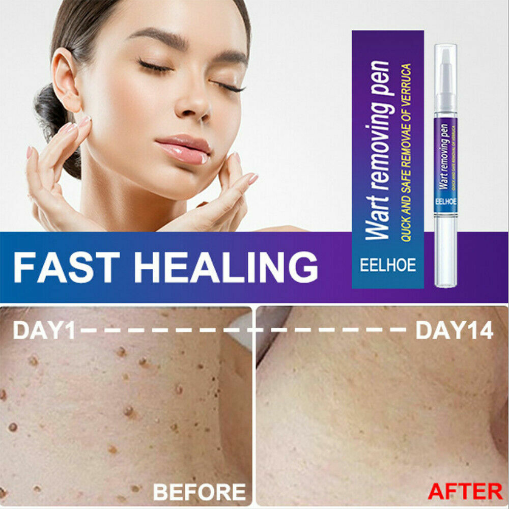 12 Hours Skin Tag Mole Wart Remover Pen Foot Corn Treatment Cream Eliminate US