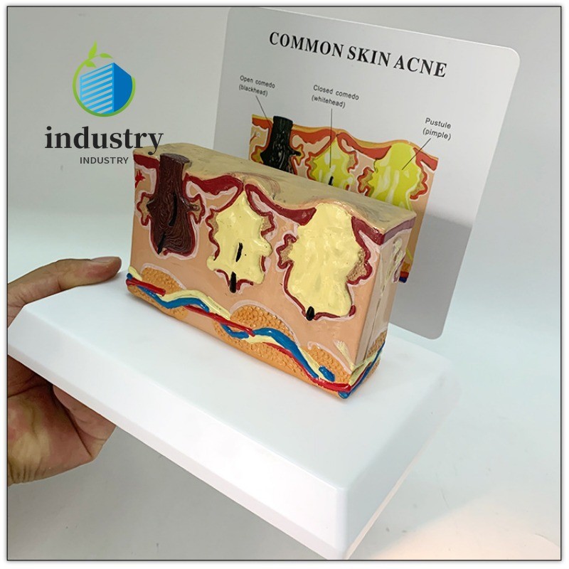 Human Pathological Skin Anatomy Hair Follicle Inflammation Model