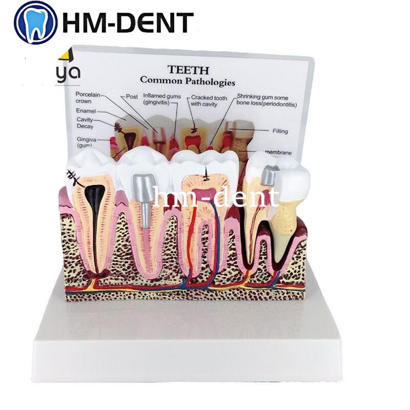 1x Anatomical Diseased Teeth and Gums Model Dental Hygiene Medical Tooth Anatomy