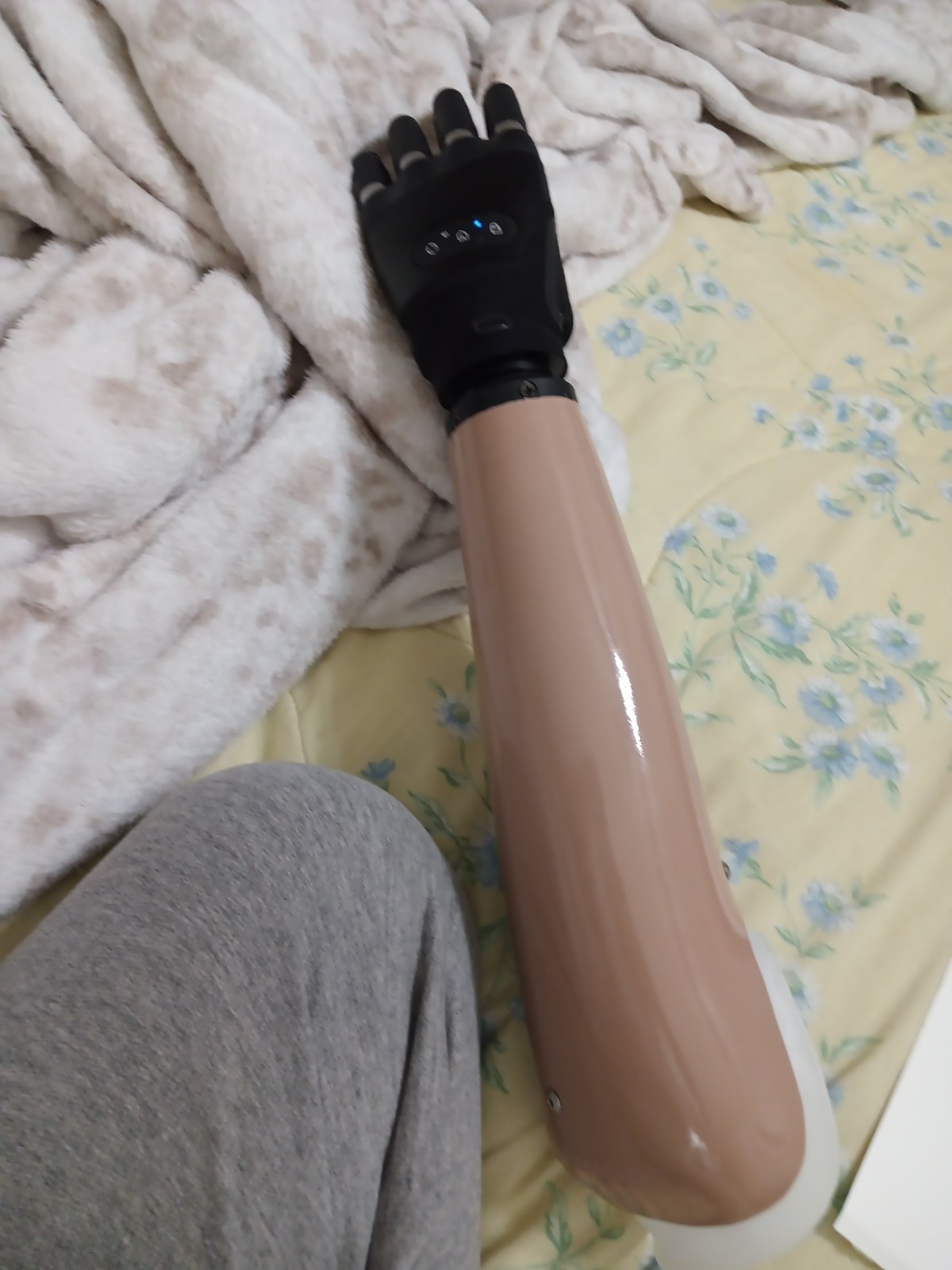 Touch Bionics i-Limb System Ottobock Myoelectric Prosthetic Hand Left