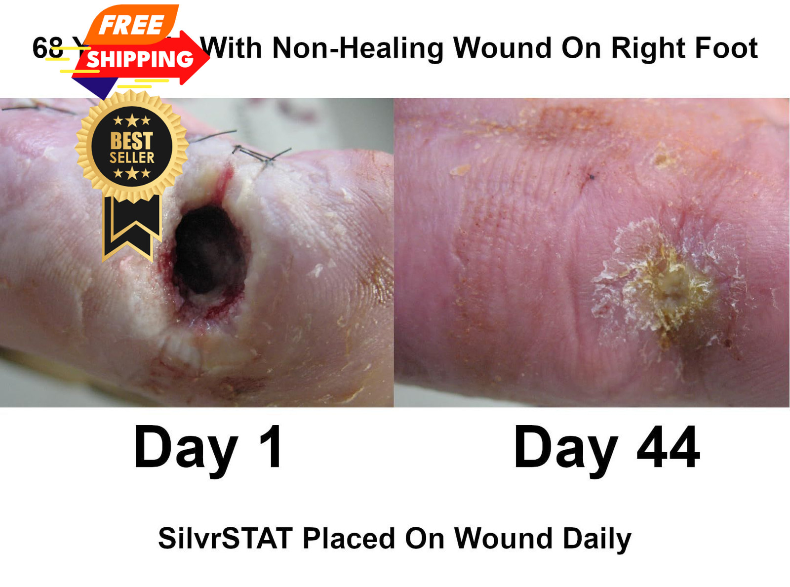 SilvrSTAT First Aid Kit Gel, 32 PPM Silver Healing Wound Dressing 3 Ounce