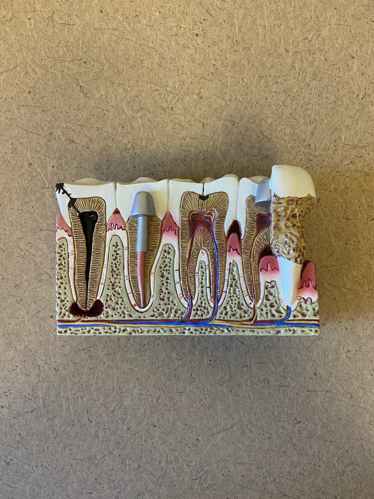 GPI Anatomicals Diseased Teeth & Gums Model
