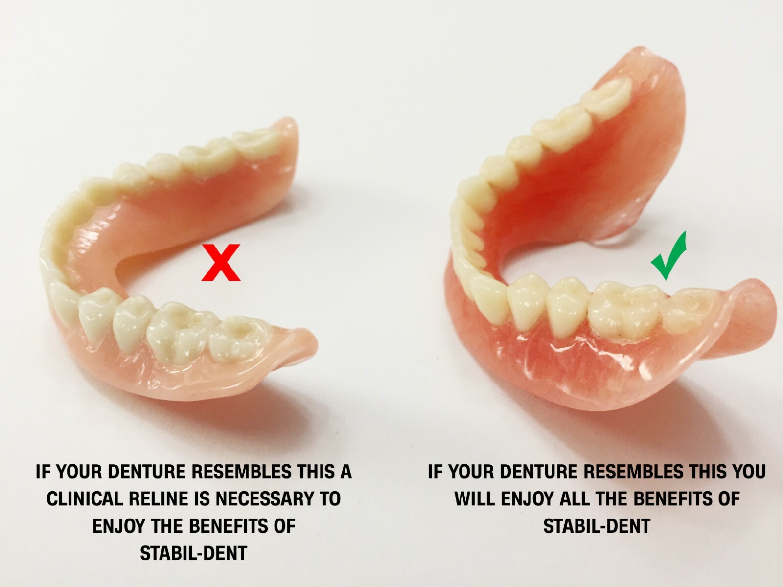 Lower Denture Stabilizers DIY Kit-Affordable Denture Stabilization