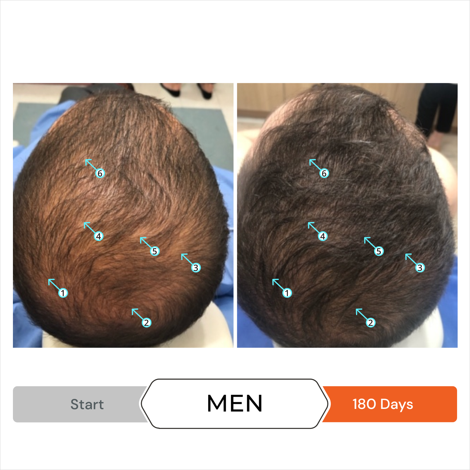 Revita | GUMMIES FOR HAIR GROWTH SUPPORT
