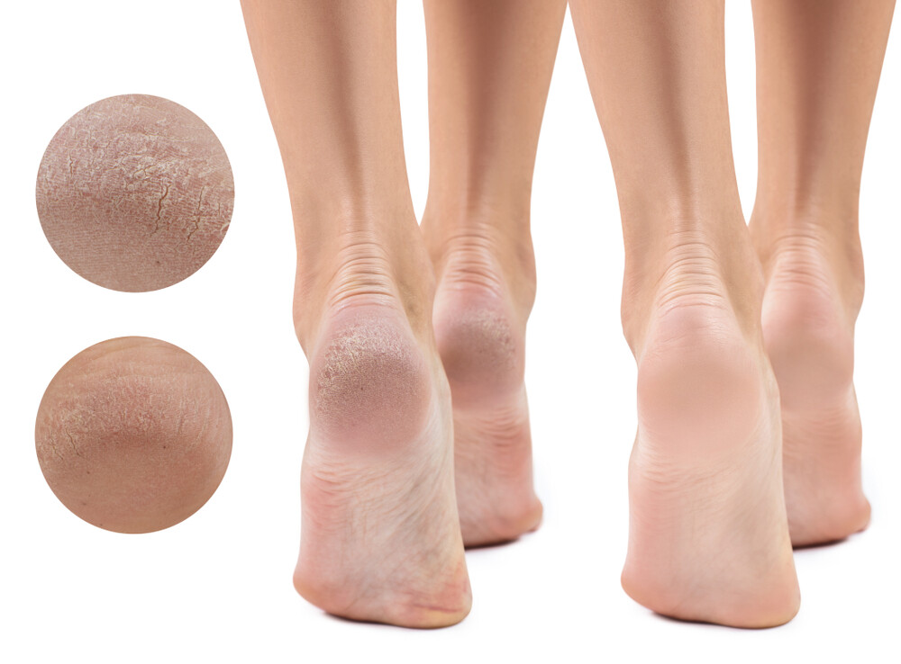 Welpida Solemates - Cracked Heel Healers