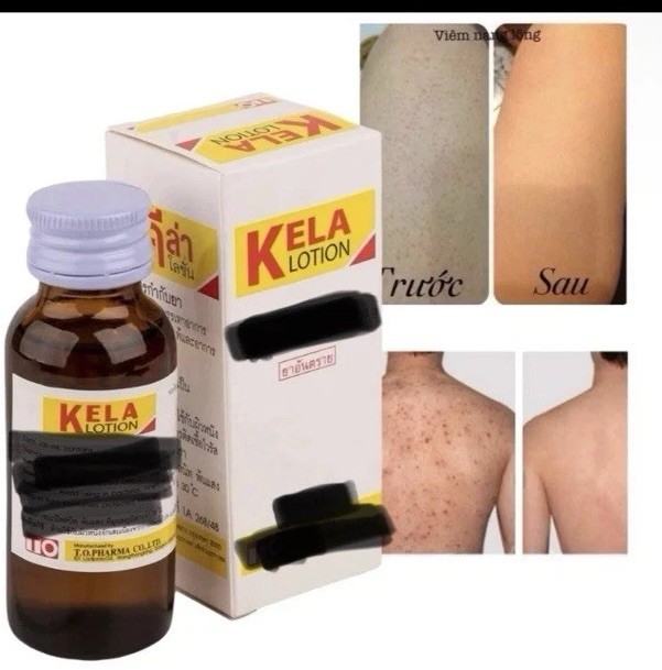 Kela Lotion 60ml  Anti-Itch Relief for Dry Psoriasis