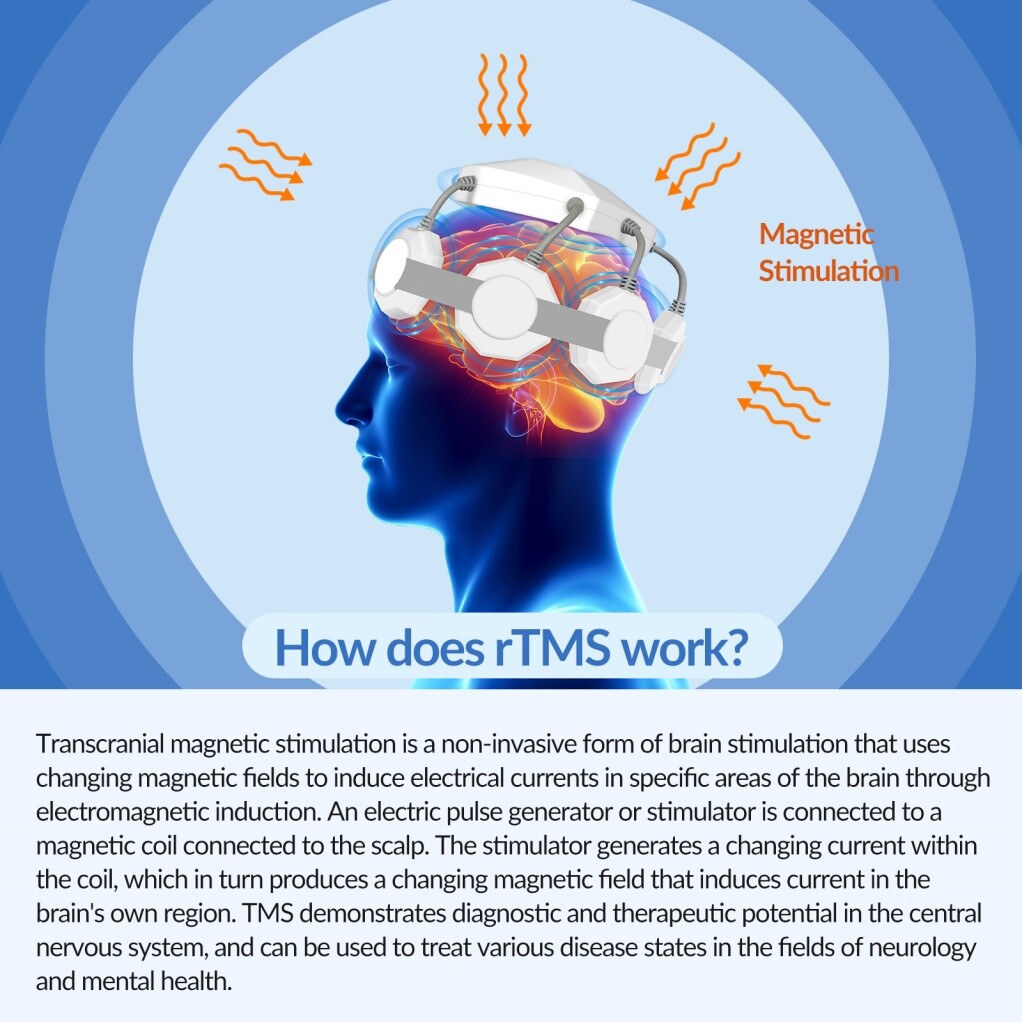 RTMS Transcranial Magnetic Stimulation for Home Medical Use for insomnia stroke