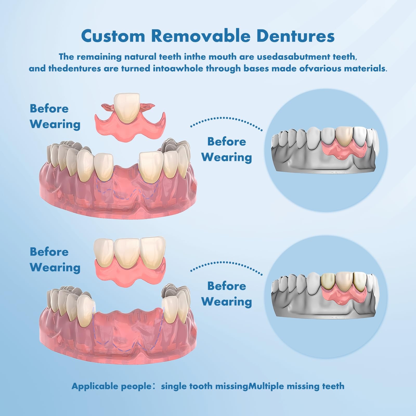 Custom Removable Dentures – Personalized Partial Denture Set for Tooth Replac...