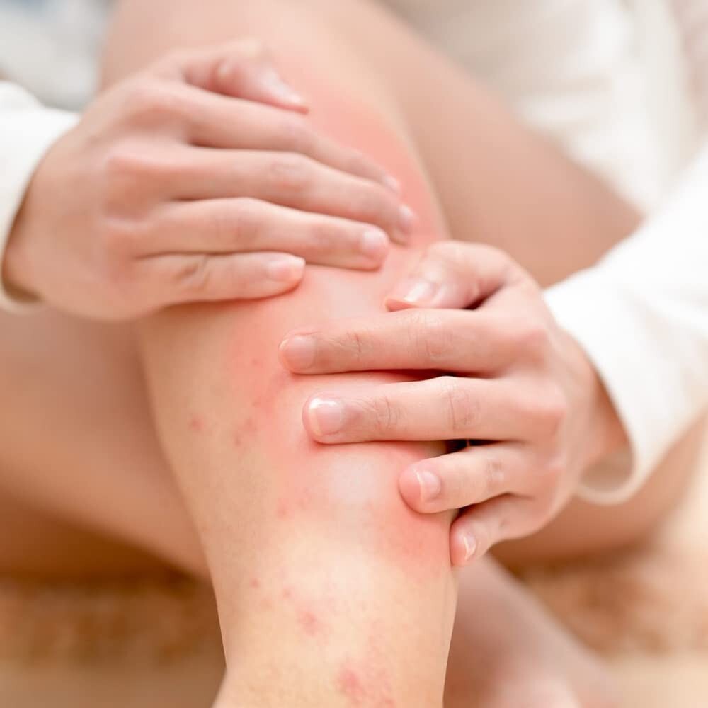 Crema Para Dermatitis Eczema Psoriasis Para Comezon Picazon Ronchas En La Piel