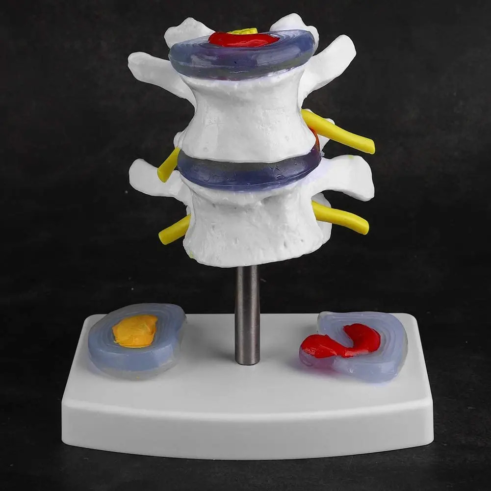 Anatomical Lumbar Disc Herniation Demonstration Model Human Spine