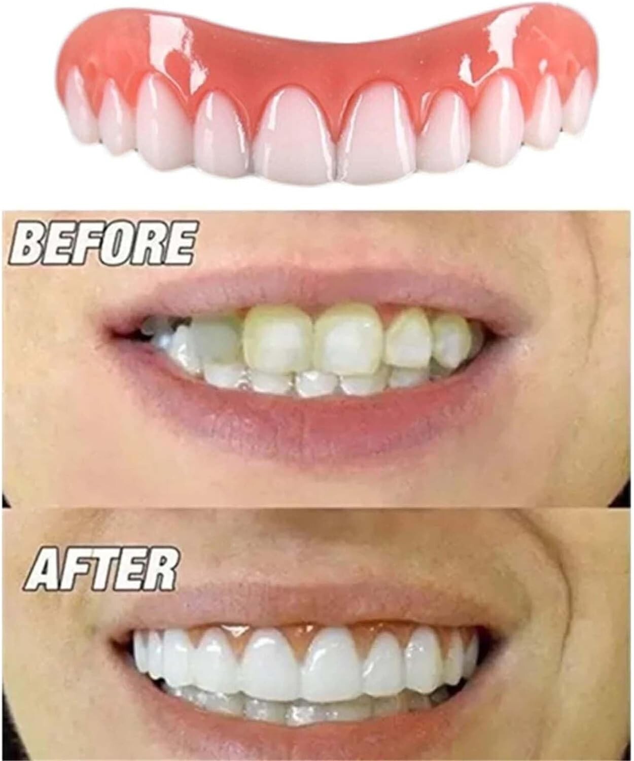Instant Smile Natural Shade Complete Teeth Makeover Kit, Upper & Lower Veneers