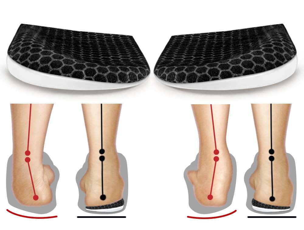 Corrective Insoles for Supination & Over-Pronation, Orthotics Medial & Latera...