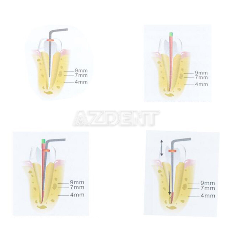 Dental Cordless Gutta Percha Obturation System Endo Heated Pen Handle/4pcs Tips