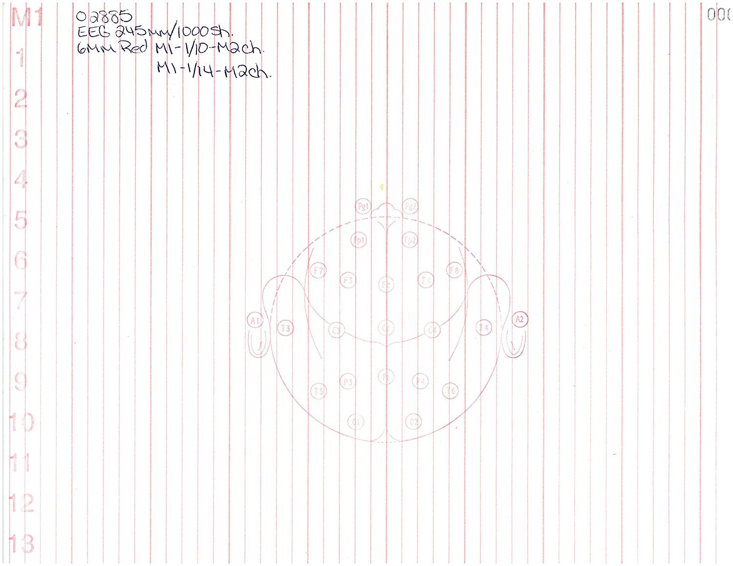EEG Paper (245MM X 300MM X 1000 SHEETS) 10/14 Channel, Fv245-30k, Head on PK 2