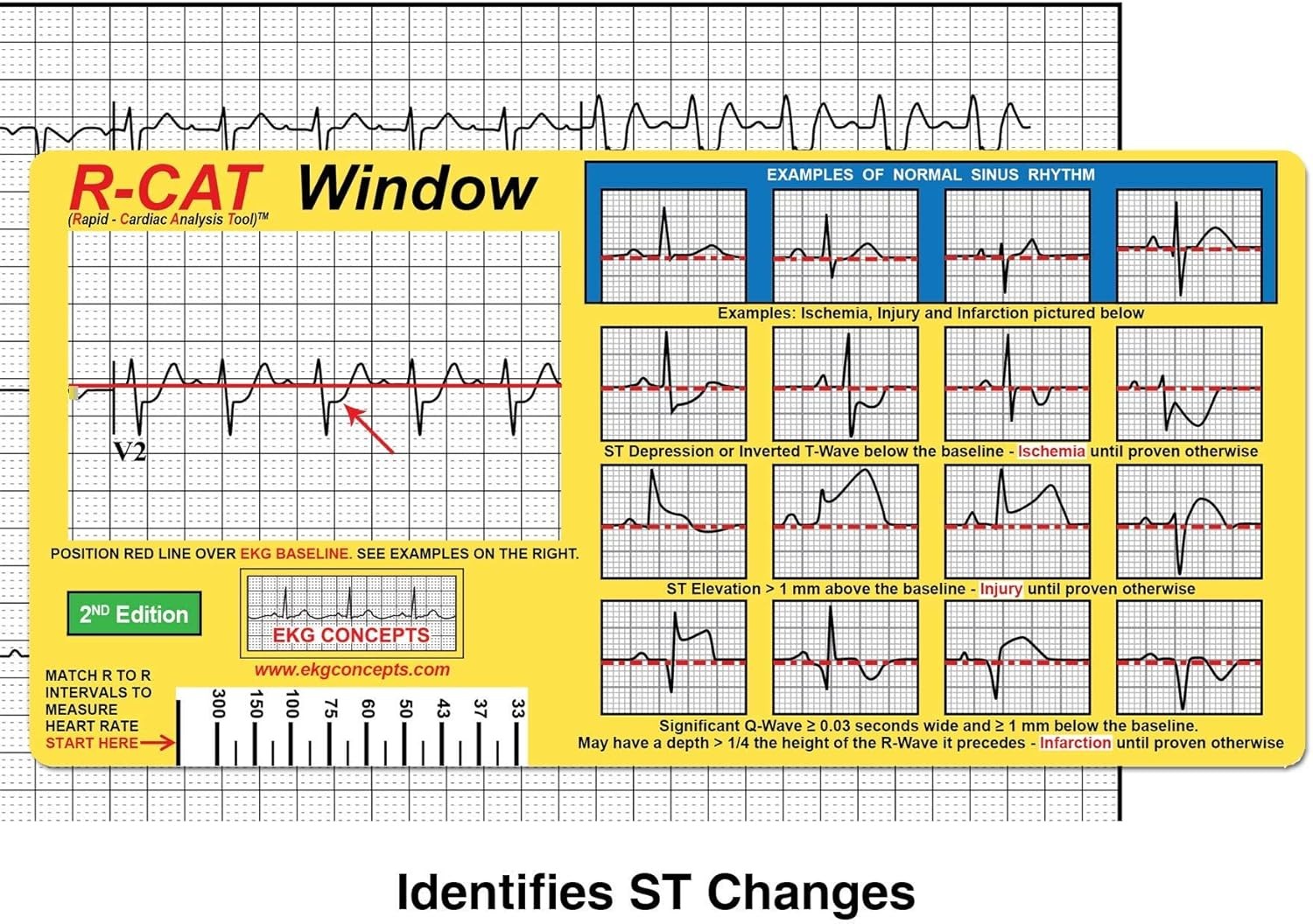 R-CAT EKG Window 2nd Edition Yellow