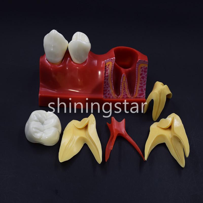 1x Dental Patient Education Study Teeth Model 4 Times Tooth Decomposition Model
