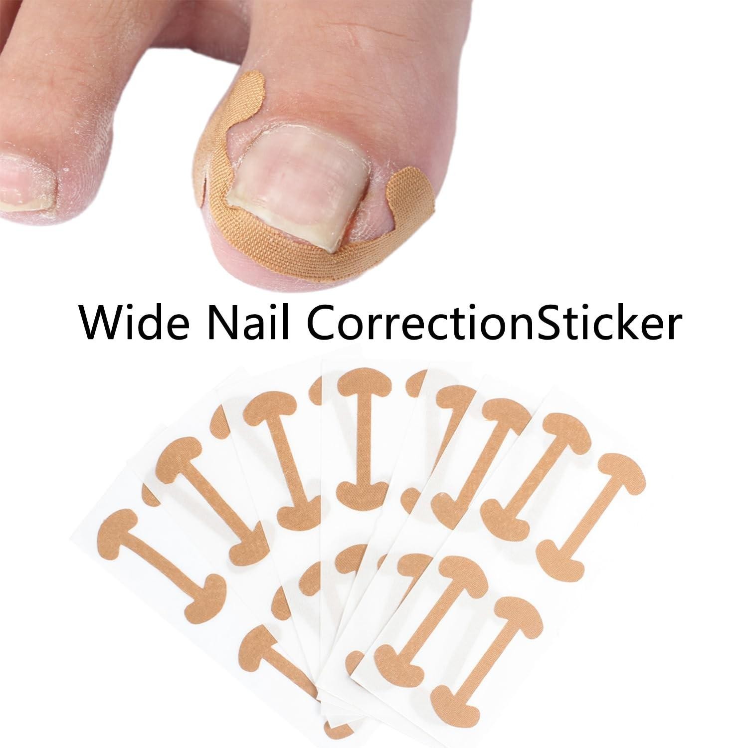 Ingrown Toenail Corrector Set with Correction Strips,professional Ingrown Toe...