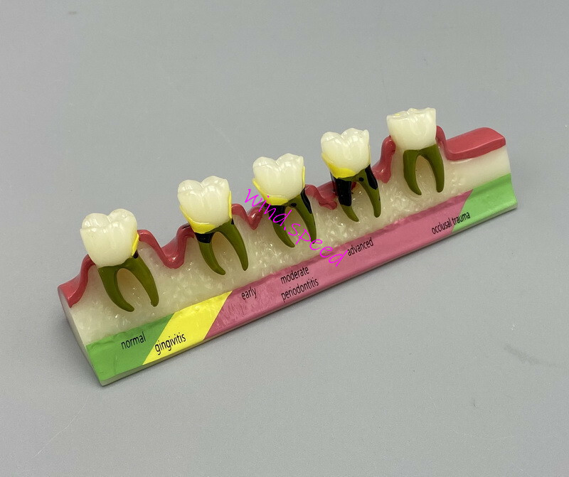 Dental Teeth Dentoform Models Caries Periodontal Disease Study Teaching Model