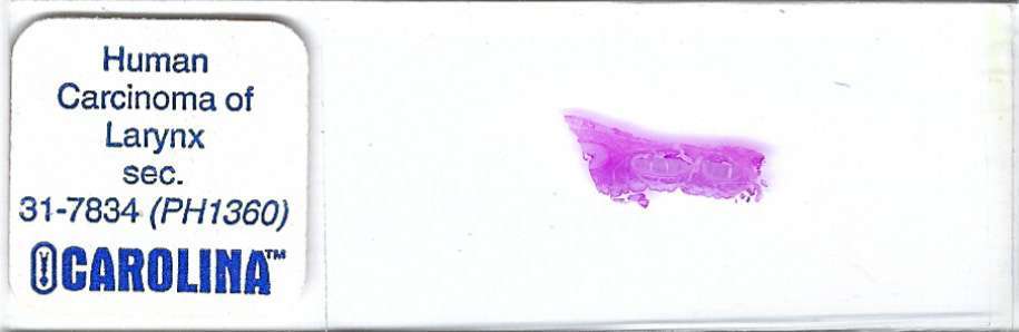 Human Carcinoma of Larynx Pathology Microscope Slide