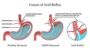 Melox for Heartburn Relief