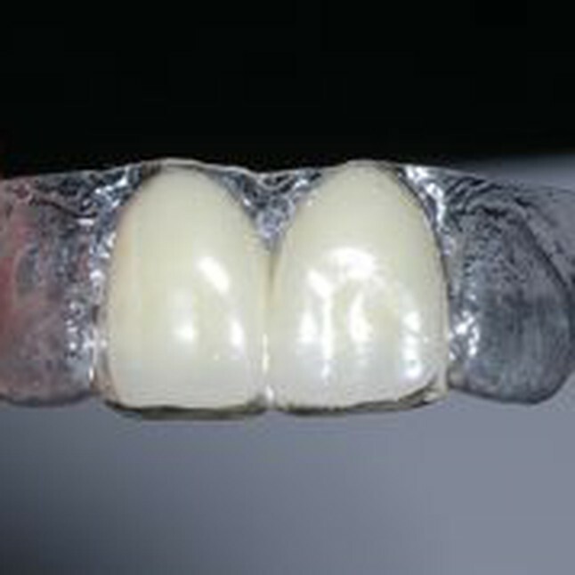 Temporary Replacement (2) teeth in Clear Retainer for Upper OR Lower, 3/way ship