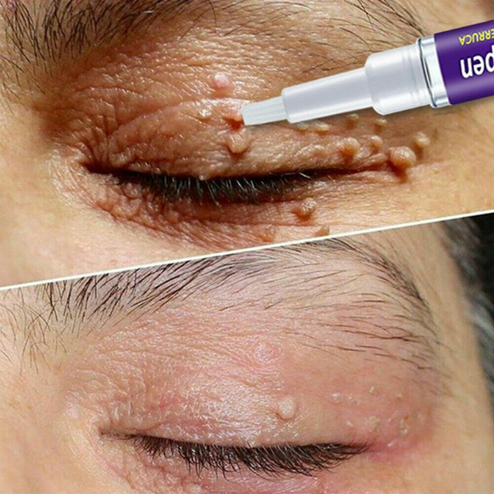 12 Hours Skin Tag Mole Wart Remover Pen Foot Corn Treatment Cream Eliminate US