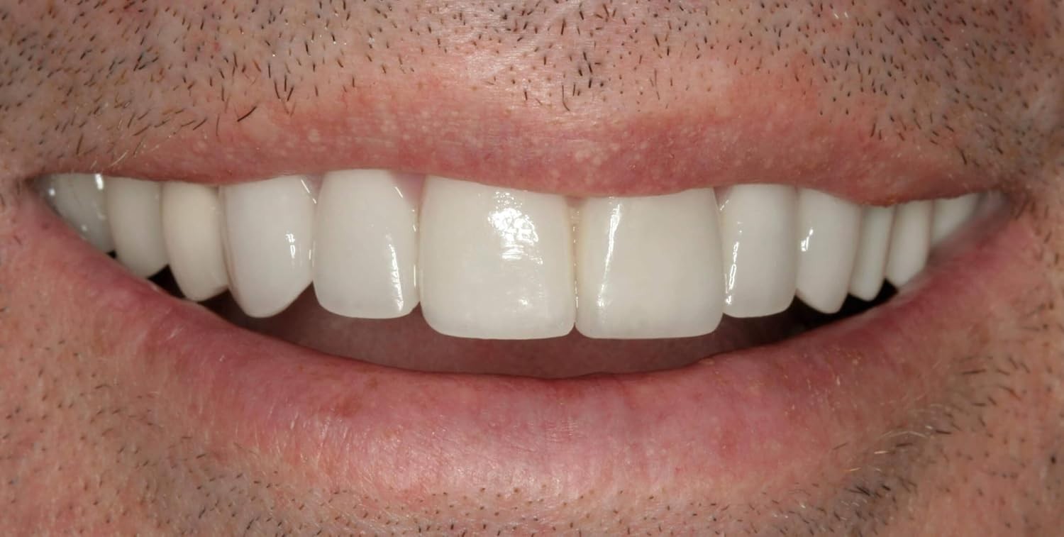 Personalized Upper and Lower Dentures - Home Solution Kit with 12 Durable Pieces