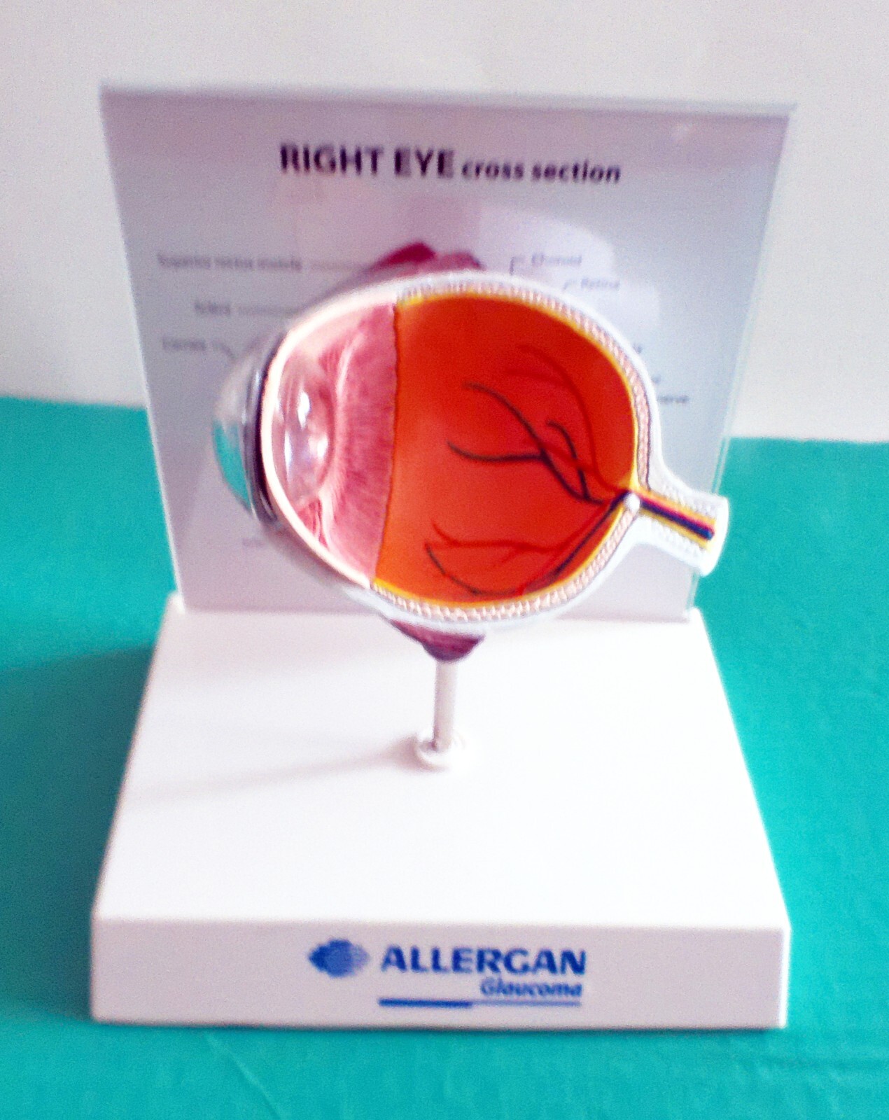 Medical Doctor's Display, Cutaway of the Human Eye with Glaucoma, New!