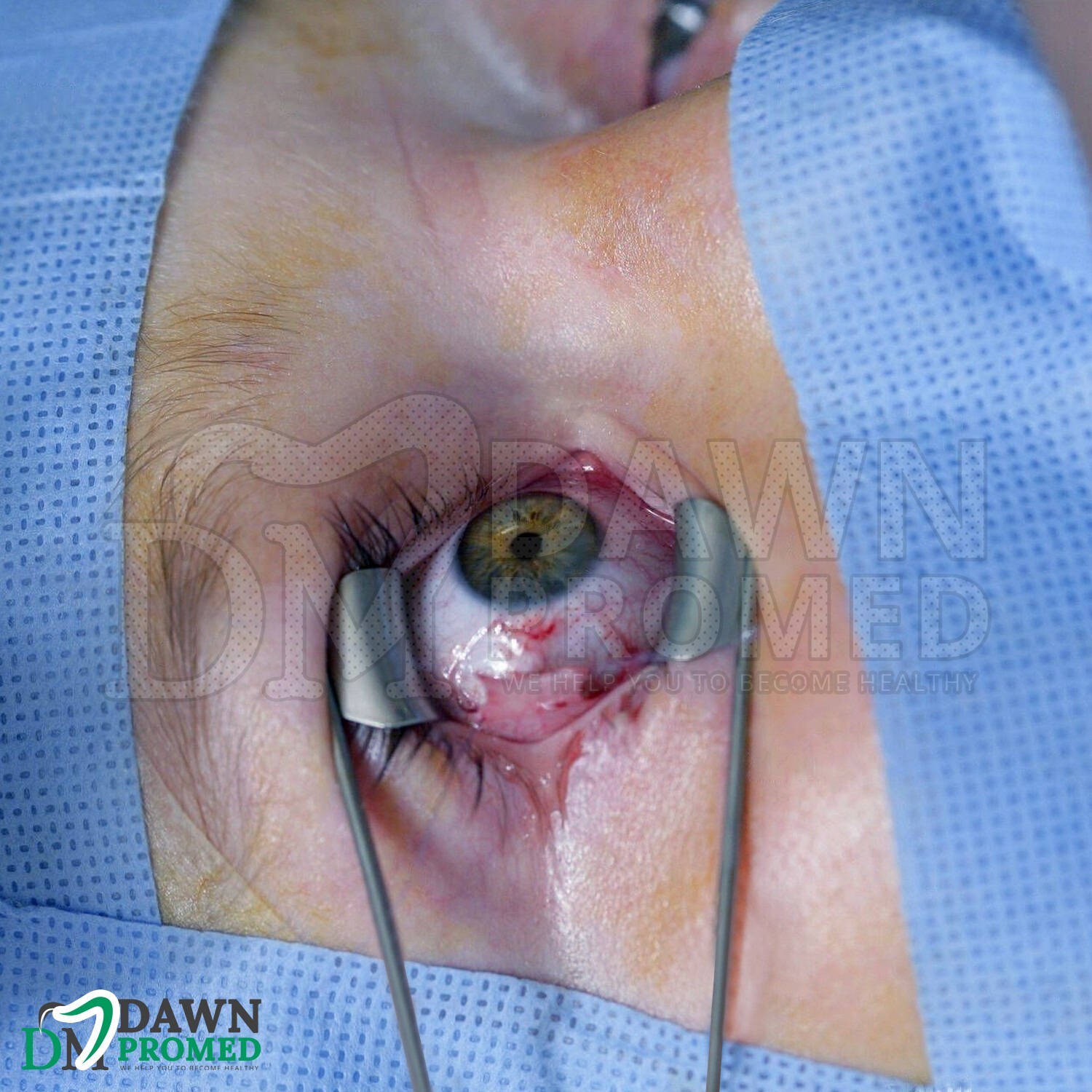 Barraquer Eye Speculum 15mm Large Solid Blades Ophthalmic ENT Instrument