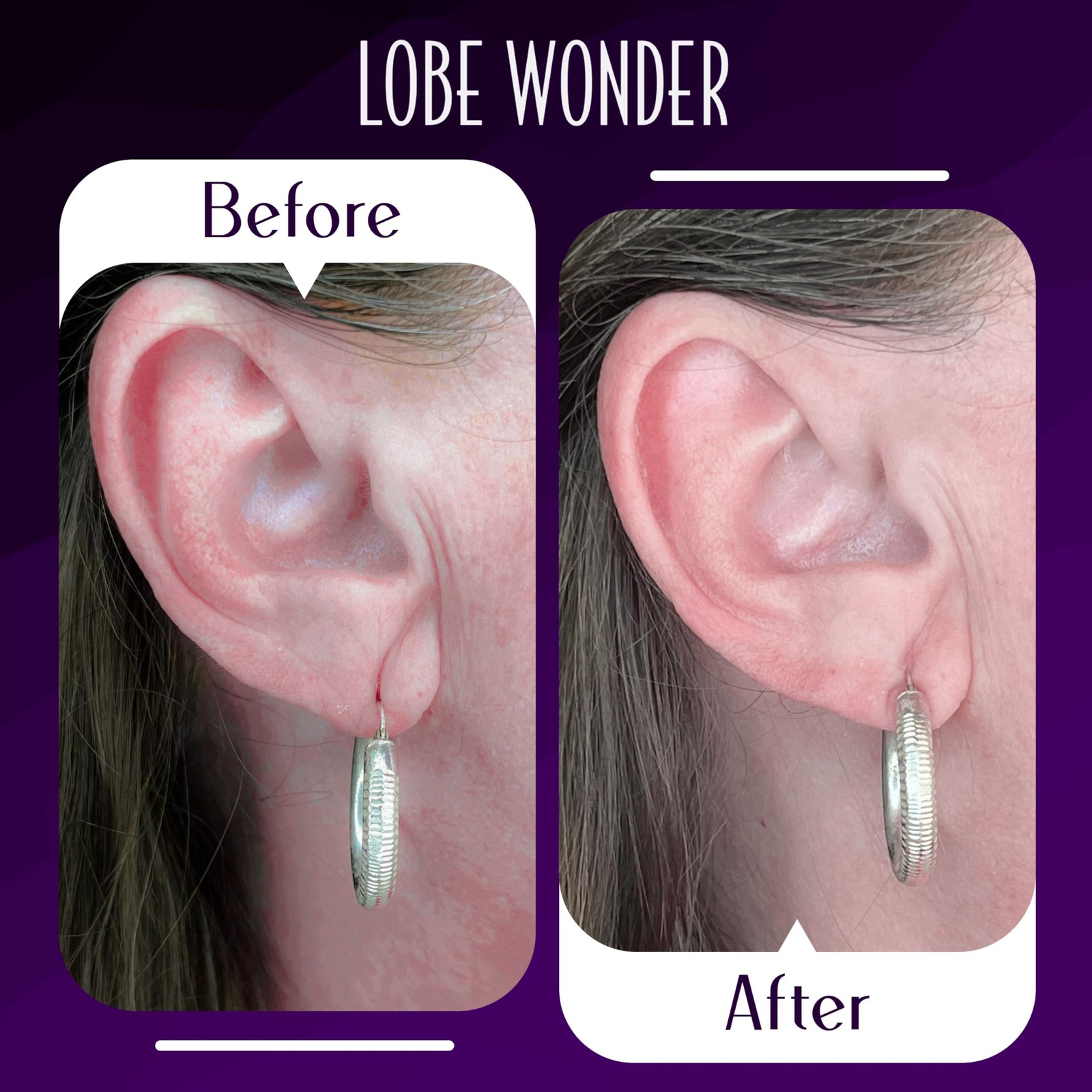 Lobe Wonder - The Original Ear Lobe Support Patch For Pierced Ears -