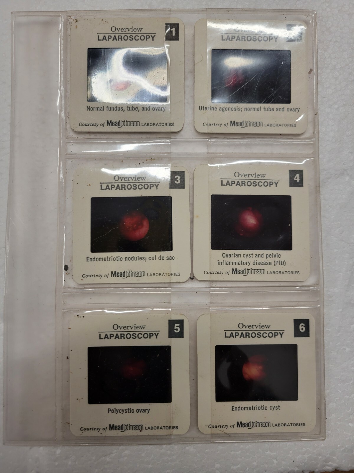 VINTAGE MEDICAL SLIDES LAPAROSCOPY SLIDES FROM MEADE JOHNSON LAB OVARIAN CYST