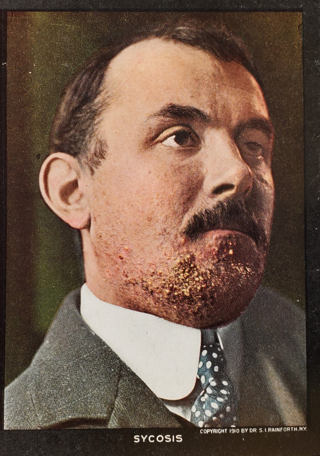 ANTIQUE 1910 MEDICAL SKIN DISEASE STEREOVIEW CARD SYCOSIS #82, RAINFORTH