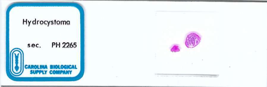 Human Hidrocystoma Pathology Microscope Slide