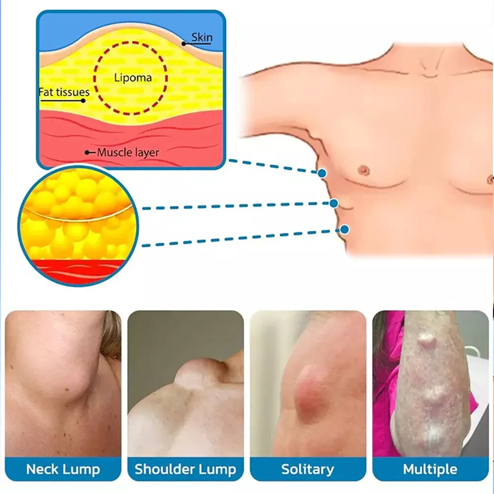 2PCS Lipomheilung Reduction Spray, Instant LumpFree Lipoma Removal Spray USA Hot