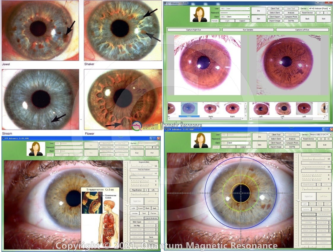 Iris Analyzer Iridology Camera Body Health Analysis Camera with Iris SoftwareNEW