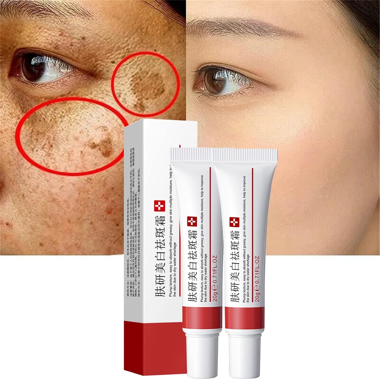 2 Pcs Whitening Freckle Cream, Acne Scar Removal Treatment Cream,...