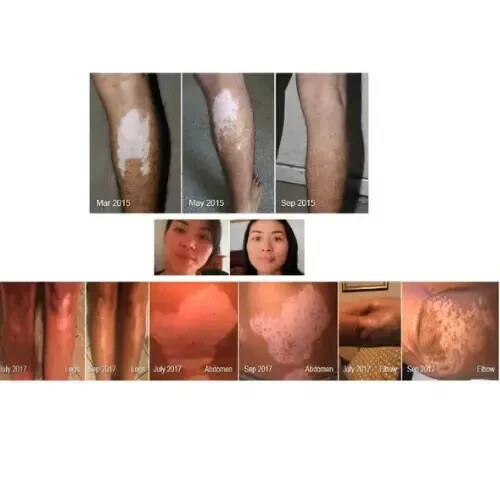 Vitiligo Organics for White Spots Skin Repair RePigmentation Repacked - 30 ml X2