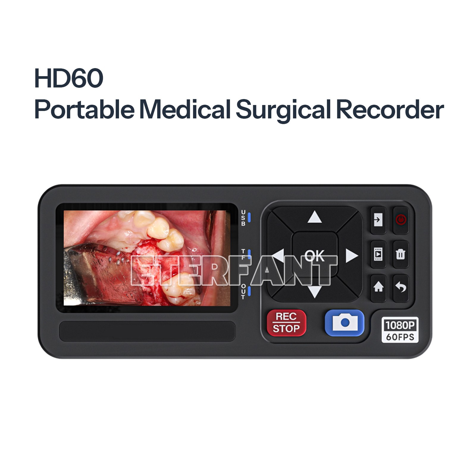 Portable Medical Surgical Recorder for Laparoscopy & Endoscopy Capture