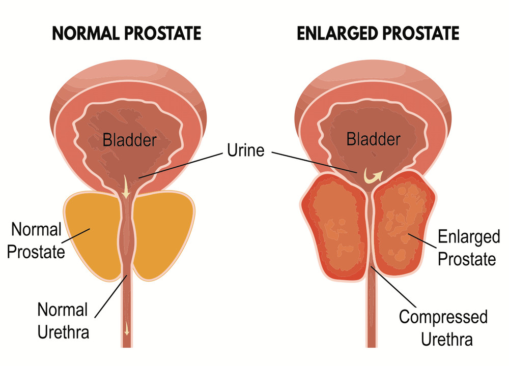 urinary pain relief- PROSTATE SUPPORT Advanced Complex -1B- Vitamin B-6