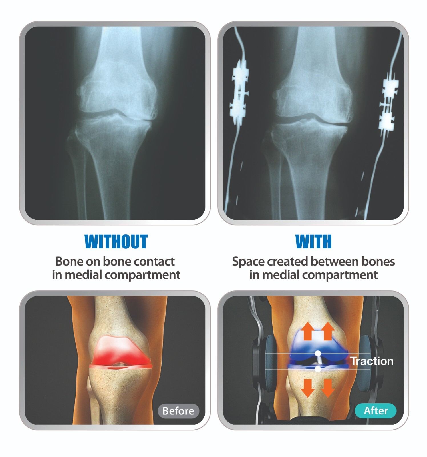 DDS OA PRO Decompression Knee Brace (Dual Unloader)