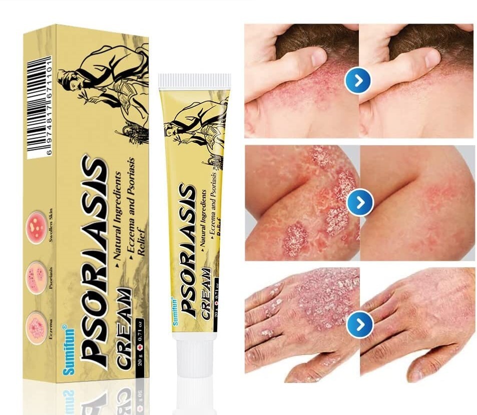 Crema Para Dermatitis Eczema Psoriasis Para Comezon Picazon Ronchas En La Piel