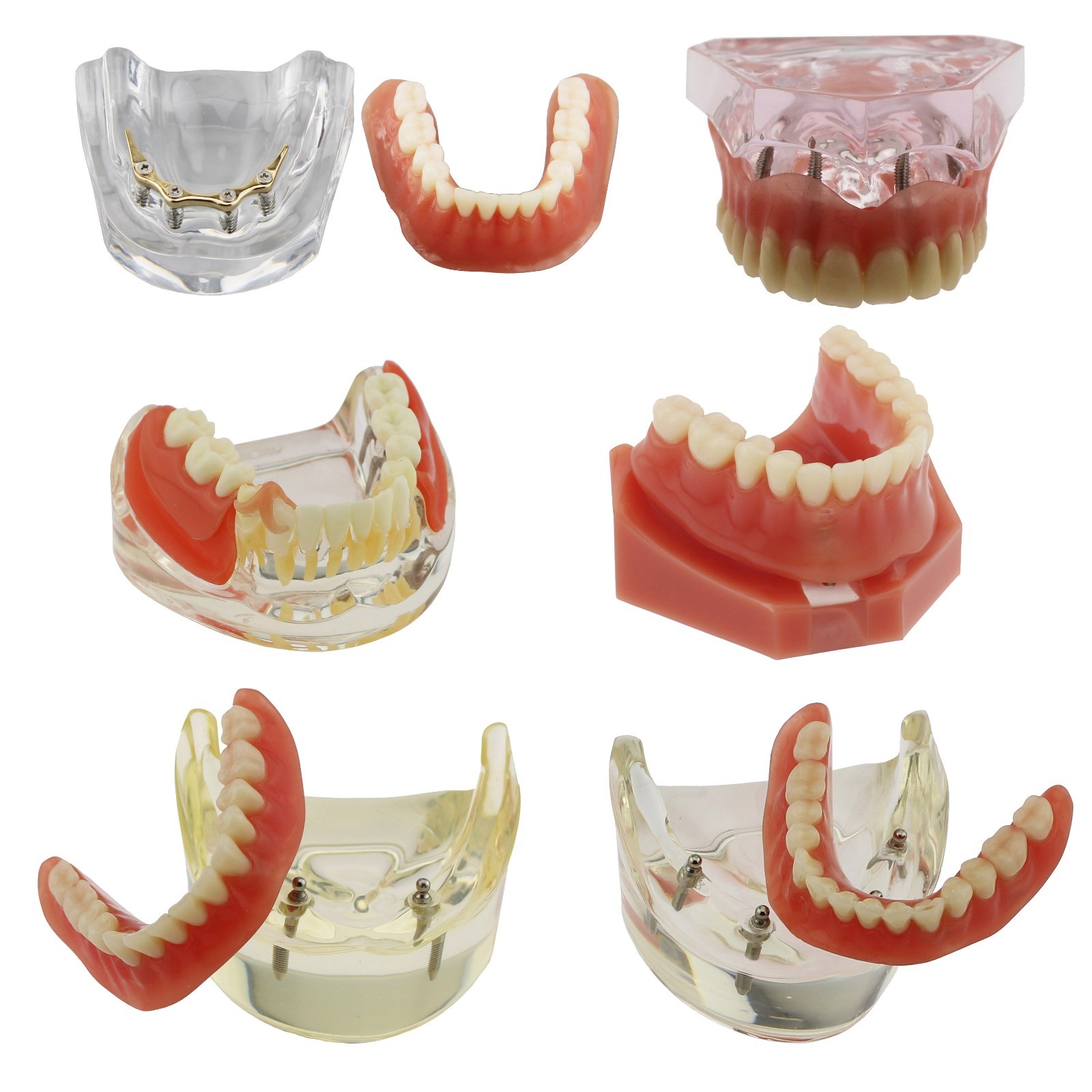 Dental Implant Restoration Model Overdenture Inferior Upper Study Demo Teaching