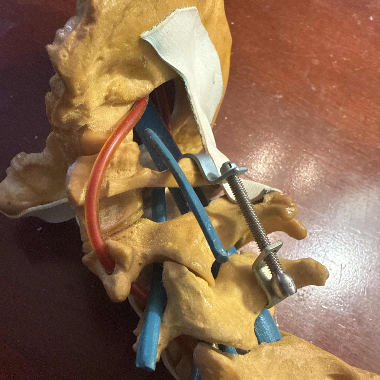 Cervical Spine Model With Fixation