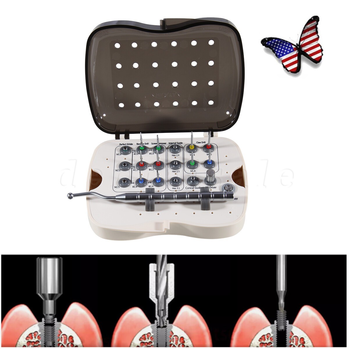 Broken Screw Removal Kit Implant Remover Rescue Tool Universal NeoBiotech OR